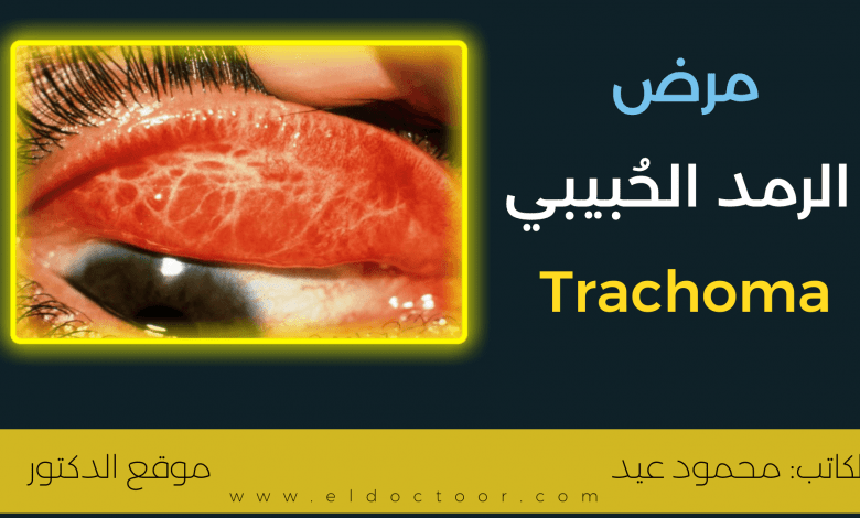 الرمد الحُبيبي (التراكوما - Trachoma) | الأسباب والعلاج