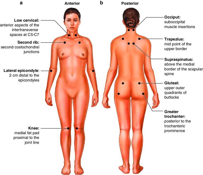 كيفية تشخيص الألم العضلي الليفي (fibromyalgia) من خلال تحديد النقاط المؤلمة (tender points) 