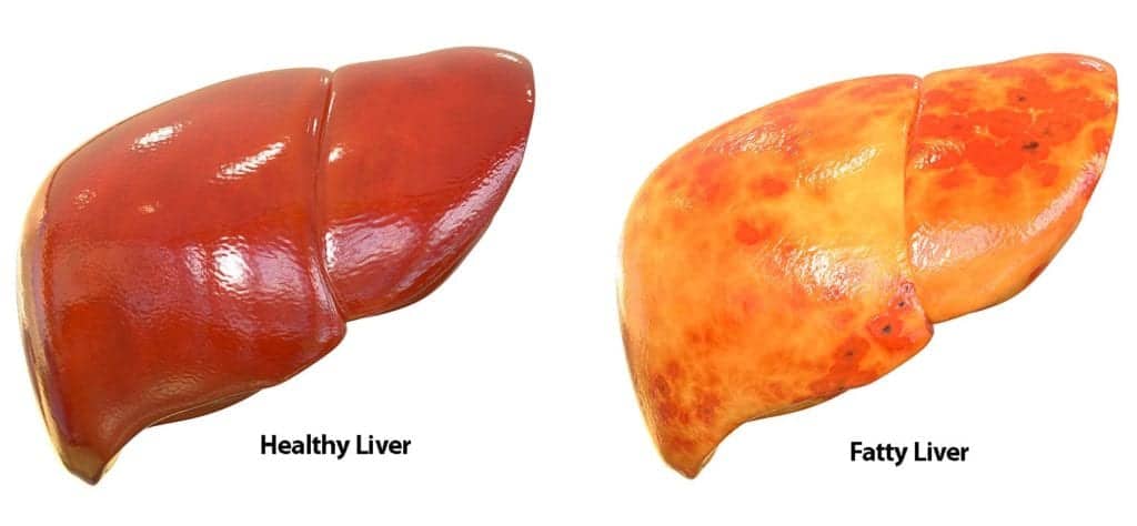 الكبد الدهني و دهون الكبد