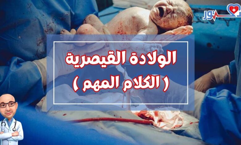 كل ما تحتاجين معرفته عن الولادة القيصرية بالتفصيل